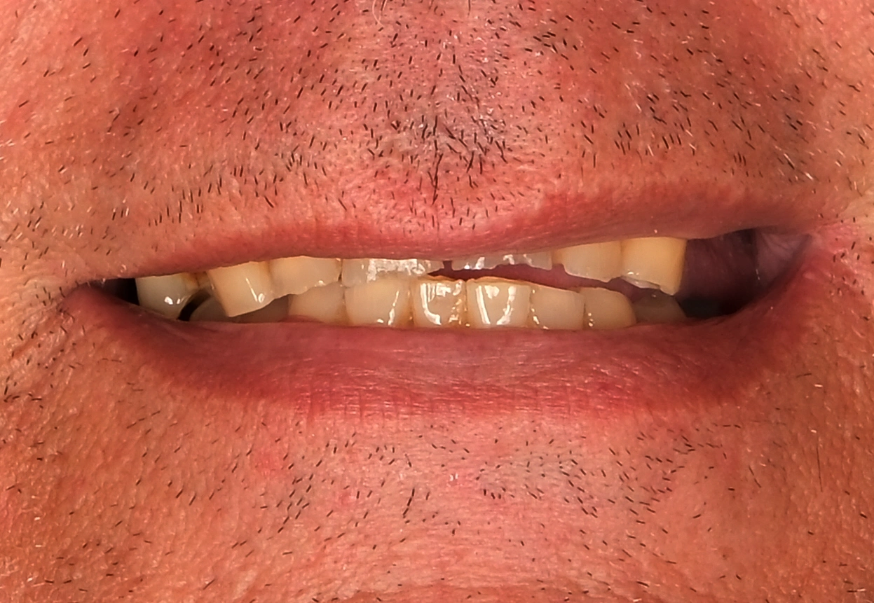 Natural Smile Makeover — Before