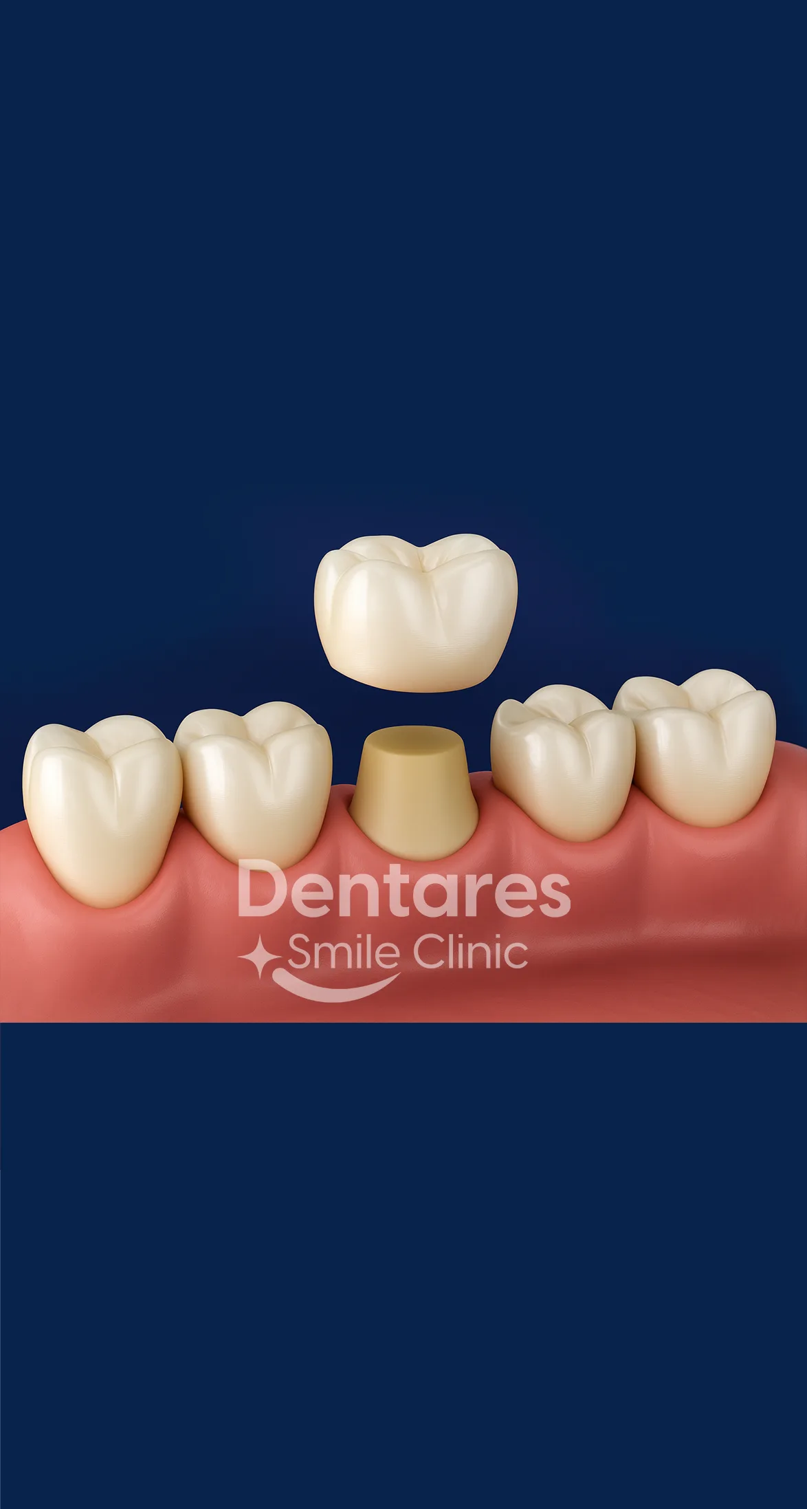 Dental Crowns
